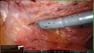 Robotic Adhesiolysis for recurrent Small Bowel Obstructions [upl. by Busby]