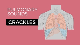 Crackles or Crepitations  Quick amp Easy Overview Easy Lung Sounds [upl. by Hendrickson998]