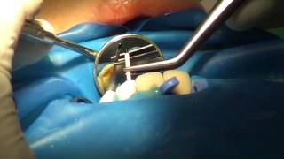 Root canal 130 filling with bioceramic paste iRoot SP  DrStefanov approach [upl. by Nalyac717]