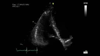 Carcinoid Syndrome [upl. by Itin]