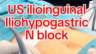 US guided Ilioinguinal iliohypogastric ns block [upl. by Lorelei]