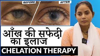 आँखों की सफेदी का इलाज  Whitish Cornea Calcific Band Keratopathy Treatment with EDTA Chelation [upl. by Auqinom]