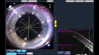 Alcon LenSx Cataract Surgery Recording HD  Med X Change [upl. by Bernardina]