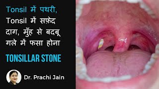 TONSILLAR STONETonsil मै पथरी मुँह से बदबू गले में दर्द  tonsil में सफ़ेद दाग  गले मैं फसा होना [upl. by Tihor]