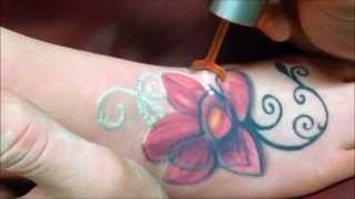 PicoWay eliminar tatuajes con láser [upl. by Anaeed]