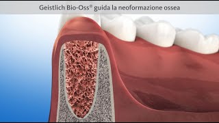 Estrazione del dente e guarigione con preservazione della cresta [upl. by Niwrek201]