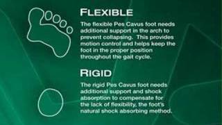 Foot Type Pes Cavus High Arch [upl. by Ferullo]