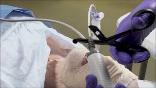 Flexible bronchoscopeguided endotracheal intubation via an igel [upl. by Buehrer433]