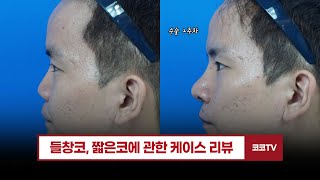 102편 들창코들린코 코수술 케이스 리뷰 편 l 수술 전2주차까지의 과정들 수술전후 수술재료 수술방법 남자코성형 20231004 [upl. by Alby]