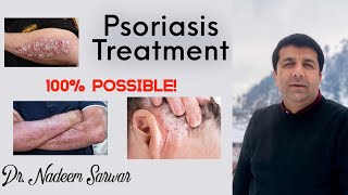 Psoriasis Treatment in Homeopathic by Dr M Nadeem Sarwar [upl. by Ahsinwad]