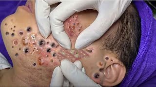 Big Cystic Acne Blackheads Extraction Blackheads amp Milia Whiteheads Removal Pimple Popping  1020 [upl. by Dalia]