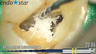 Endodontic case done by Dr Zaher AlTaqi using Endostar E3 Azure [upl. by Aizan]