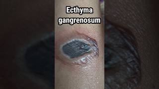 Ecthyma gangrenosum  Pseumonus infection skin disease [upl. by Ayatahs375]