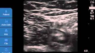 Ultrasoundguided Saphenous Nerve Block [upl. by Berlin950]