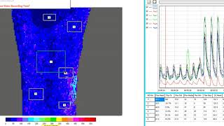 Firefly Recovery Clinical Video using Laser Speckle Analysis [upl. by Olim]