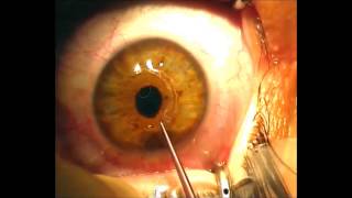 Implantation of Intrastromal Corneal Ring Segments for Keratoconus [upl. by Palecek655]