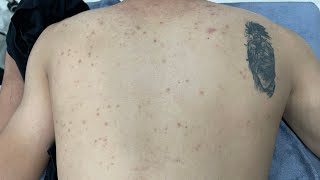 ACNE TREATMENT VU QUYNH MI Acne On Boys Back 2024 [upl. by Adnilav]