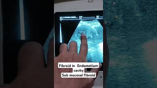 Endometrium fibroid sub mucosal shortyoutubevideo loveultrasound pregnant pregnant [upl. by Baily863]