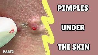 Acne treatment under the skin Relax with bye pimple🧡 [upl. by Ecaroh]