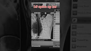 X ray ls spine ap lat anatomy medicalimaging science xraytechnician xrayart xraytechnologis [upl. by Argyle145]