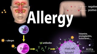 Allergy  Mechanism Symptoms Risk factors Diagnosis Treatment and Prevention Animation [upl. by Brass832]