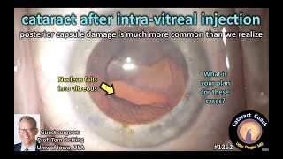 CataractCoach 1262 cataract after intravitreal injection posterior capsule damage [upl. by Eilatam]