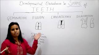 fusion Developmental tooth anomaly By Dr Prerna Shrivastava career Hub medical institute bhopal [upl. by Olodort460]