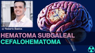 HEMATOMA SUBGALEAL X CEFALOHEMATOMA SAIBA DIFERENCIAR [upl. by Regnig]