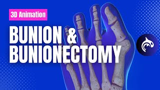 Bunion and Bunionectomy with Osteotomy  3D Animation [upl. by Nnyleve]