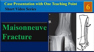 Maisonneuve Fracture Case Presentation with One Teaching Point [upl. by Annaet291]