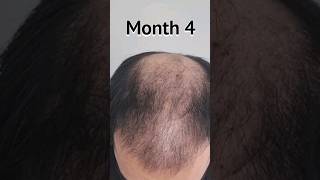 FUE Hair Transplant Timeline  Day 1 to Day 365  Before amp After  6100 Grafts hairtransplant [upl. by Aikmat]