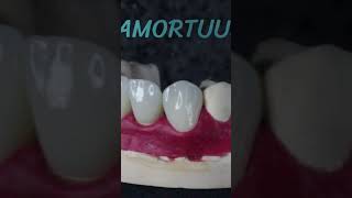 anatomy exocad implants stomatology zro2 emaxveneers emaxpress dentist design tooth [upl. by Vivienne974]