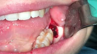 Quick lower wisdom tooth extraction [upl. by Buff]