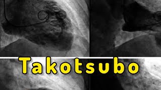 Takotsubo Cardiomyopathy “Broken Heart Syndrome” [upl. by Costanzia]