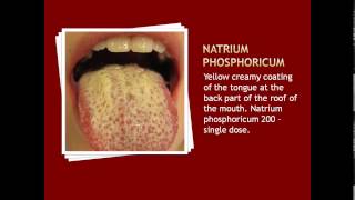 Tongue treatment in homeopathy by Dr Teja Sree [upl. by Aiem663]