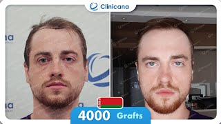 Check out Valerys Hair transplant experience at Clinicana [upl. by Aileen]