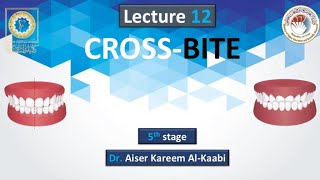 Crossbite Lec12 stage5 [upl. by Novak]