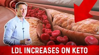 Cardiologist Dr Nadir Ali Explains LDL Bad Cholesterol Spike With Keto – DrBerg [upl. by Lanza]