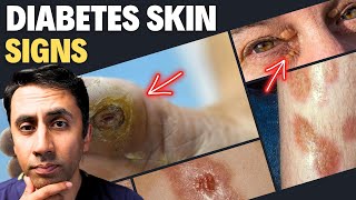 Doctor Explains 13 Skin Signs of Diabetes  Never Ignore These Symptoms High Sugar [upl. by Worden]