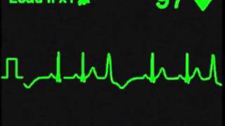 Ventricular Trigeminy [upl. by Taber]