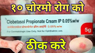 Clobetasol Cream use For एग्जिमा एलर्जी Damataitisskin rashes  soriasis  Review in hindi [upl. by Ames]