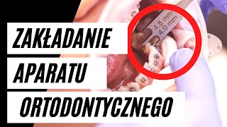 Zakładanie aparatu ortodontycznego  krok po kroku  VLOG3 [upl. by Annunciata]