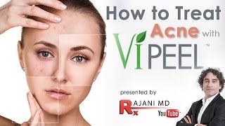 Vi PEEL ACNE  Chemical Peel for Acne Scaring [upl. by Laurena]