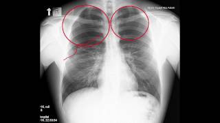 Pneumothorax Radiology in two minutes [upl. by Cirone]