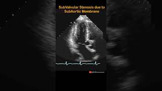 Subvalvular Aortic Stenosis cardiology echocardiography shorts echocardiogram aorticstenosis [upl. by Alleoj]