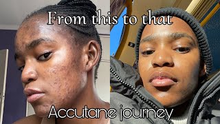 My Accutane journey  Going back on accutane and its side effects [upl. by Polash104]