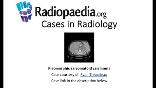 Pleomorphic sarcomatoid carcinoma Radiopaediaorg Cases in Radiology [upl. by Chelsy147]