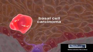 Basal Cell Carcinomas Medical Animation Video 3D [upl. by Amaral326]