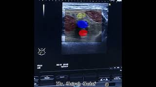 Sciatic nerve block at Popliteal fossa by Dr Sairah Sadaf for fx Tibia [upl. by Derron]