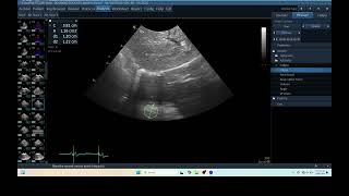 IQ 276 TFAST LUNG MASS ULTRASOUND ECHOPAC ANALYSIS 3 4 [upl. by Yellac]